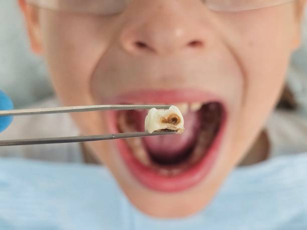 Best Emergency Tooth Extraction in Santa Fe, TX
